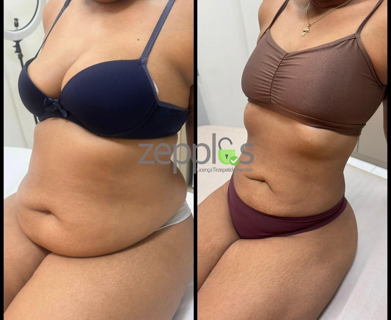 Antes e Depois Paciente 4