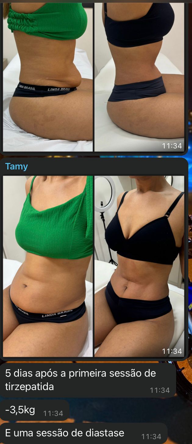 Antes e Depois Paciente 1